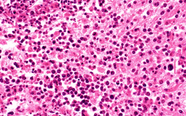 6B2 Lymphoma (Case 6) N4 H&E 1