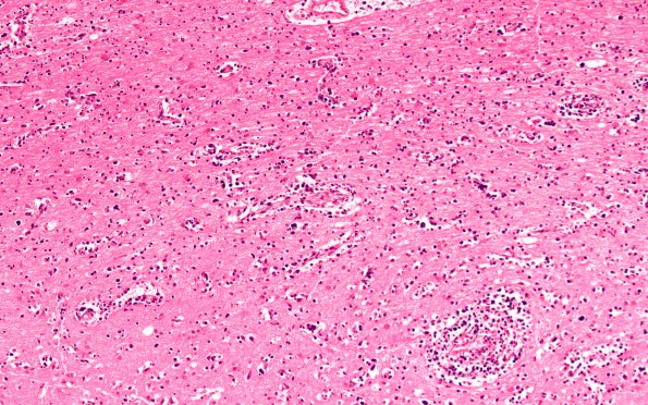 6B5 Lymphoma (Case 6) N1 H&E 10X