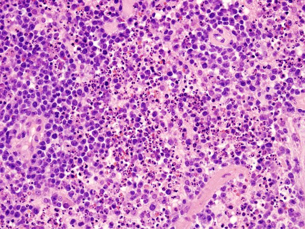 7A3 Lymphoma (2-3 day steroid Rx, Case 7)  3