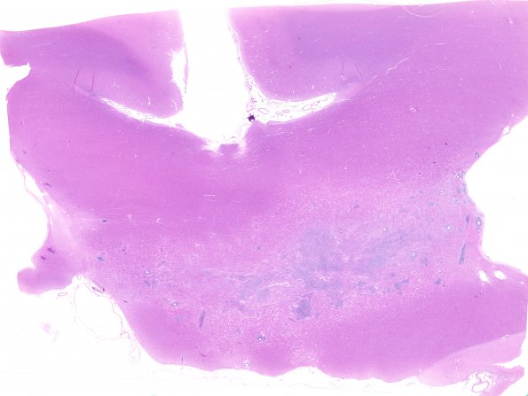 7C3 Lymphoma (Case 7) H&E whole mount