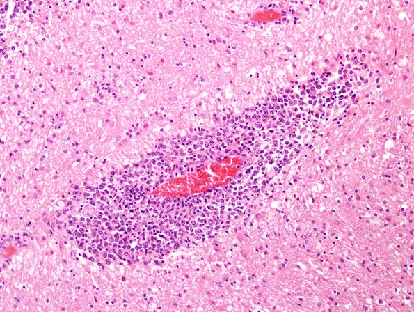 7C4 Lymphoma (Case 7) H&E 4