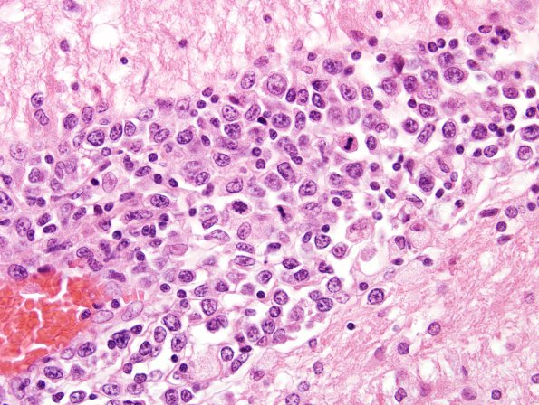 7C5 Lymphoma (Case 7) H&E 2