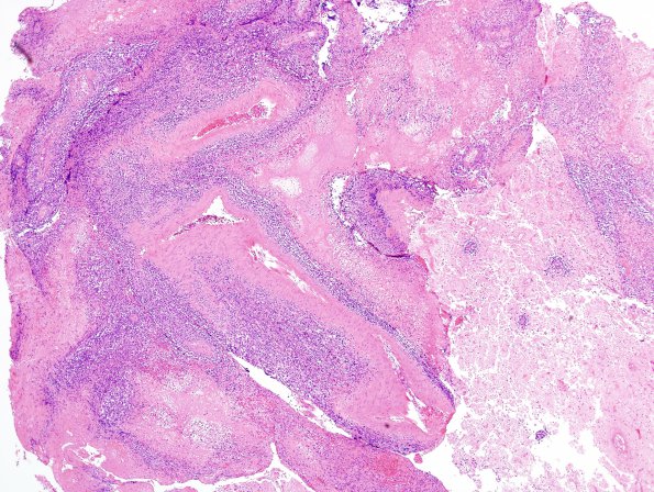 8A2 Lymphoma p 10days steroids (Case 8) H&E 3A