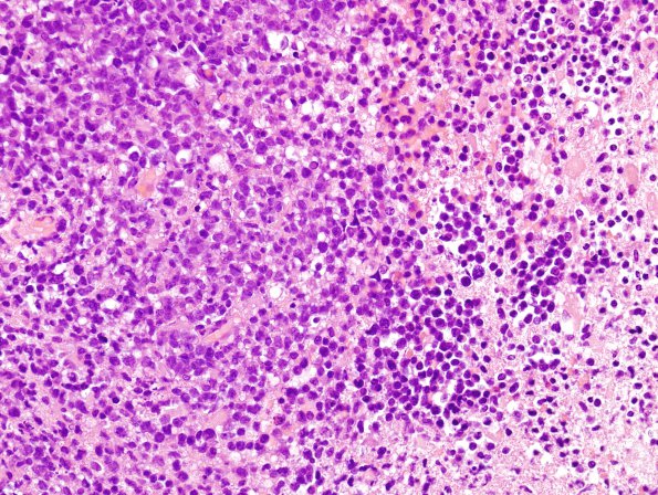 8A4 Lymphoma p 10days steroids (Case 8) H&E 4