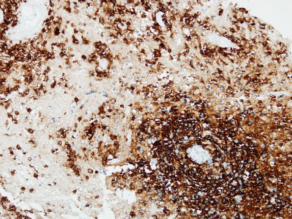 8B1 Lymphoma p 10days steroids (Case 8) CD20 1A