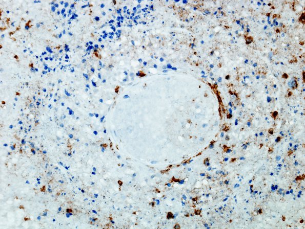 8C Lymphoma p 10days steroids (Case 8) CD3 2A