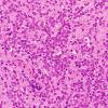 9A1 Lymphoma, DLBCL, GCT (Case 9) H&E 6