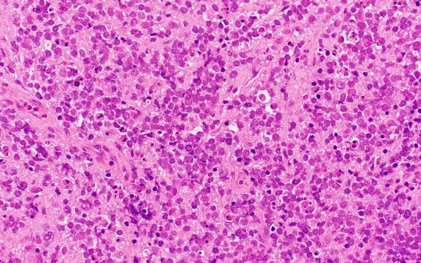 9A1 Lymphoma, DLBCL, GCT (Case 9) H&E 6