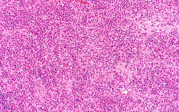 9A2 Lymphoma, DLBC, GCT (Case 9) H&E 20X