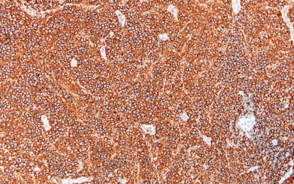 9B1 Lymphoma, DLBCL, GCT (Case 9 CD20 1