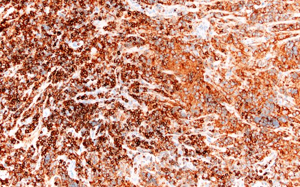 9B2 Lymphoma, DLBC, GCT (Case 9) CD45 20X