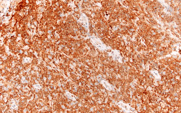 9C1 Lymphoma, DLBC, GCT (Case 9) CD10