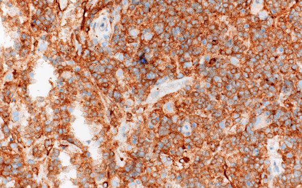 9C2 Lymphoma, DLBCL, GCT (Case 9) CD10 2