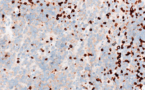 9D Lymphoma, DLBCL, GCT (Case 9) CD3 40X