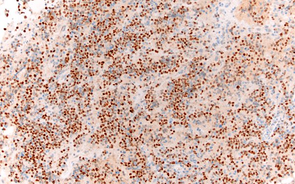 9E1 Lymphoma, DLBC, GCT (Case 9) BCl-6 20X