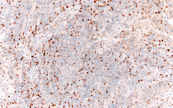 9F1 Lymphoma, DLBC, GCT (Case 9) c-MYC 20X