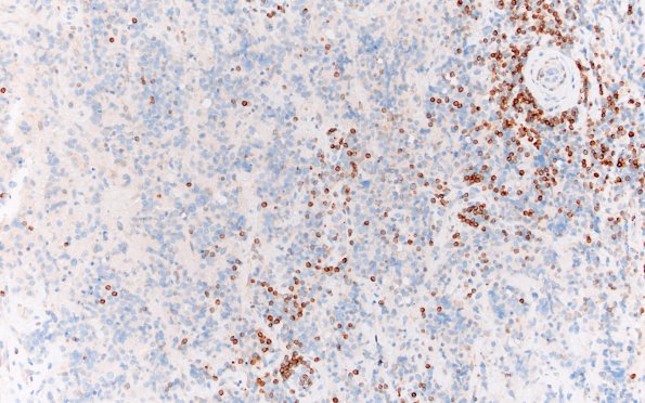 9F2 Lymphoma, DLBC, GCT (Case 9) BCl-2 20X