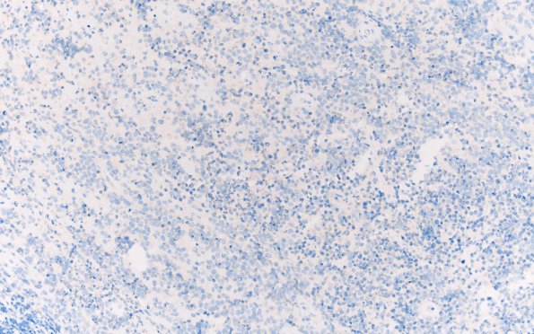 9F3 Lymphoma, DLBC, GCT (Case 9) CD30