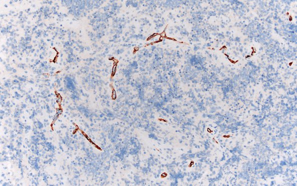 9F4 Lymphoma, DLBC, GCT (Case 9) CD34 20X