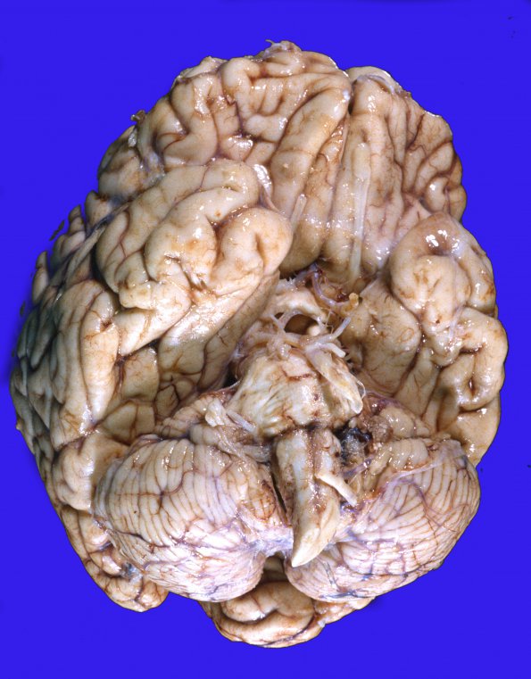 12A1 Lymphoma, secondary (Case 12)