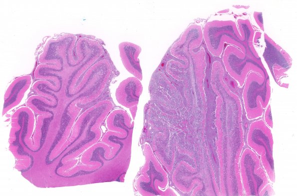 12B1 Lymphoma, secondary (Case 12) H&E WM