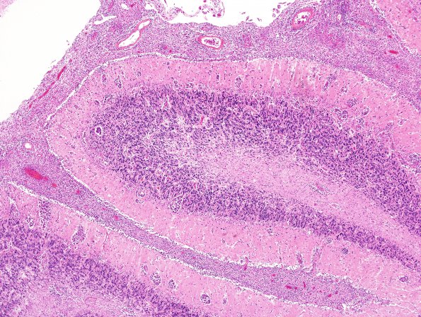 12B2 Lymphoma, secondary (Case 12) H&E 1