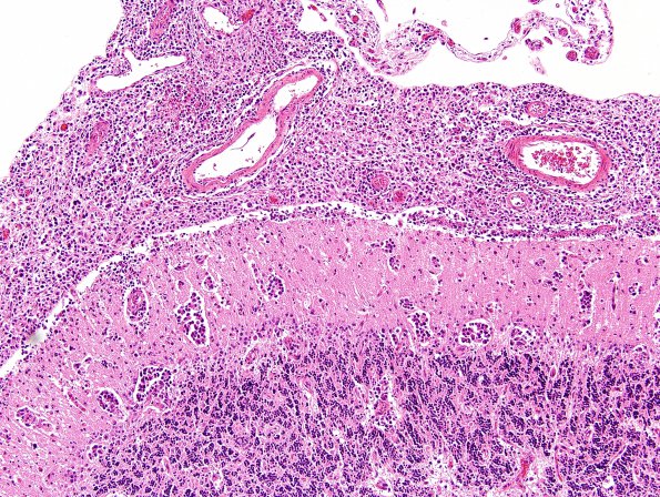 12B3 Lymphoma, secondary (Case 12) H&E 2