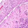 12B4 Lymphoma, secondary (Case 12) H&E 3