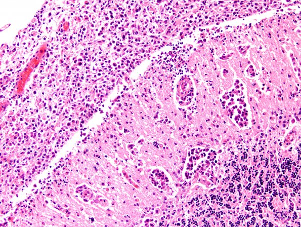 12B4 Lymphoma, secondary (Case 12) H&E 3