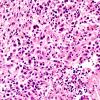 12B5 Lymphoma, secondary (Case 12) H&E 4