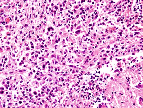 12B5 Lymphoma, secondary (Case 12) H&E 4