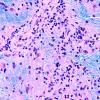 13C5 Lymphoma, ADEM Mimic (Case 13) LFB-H&E 40X 4