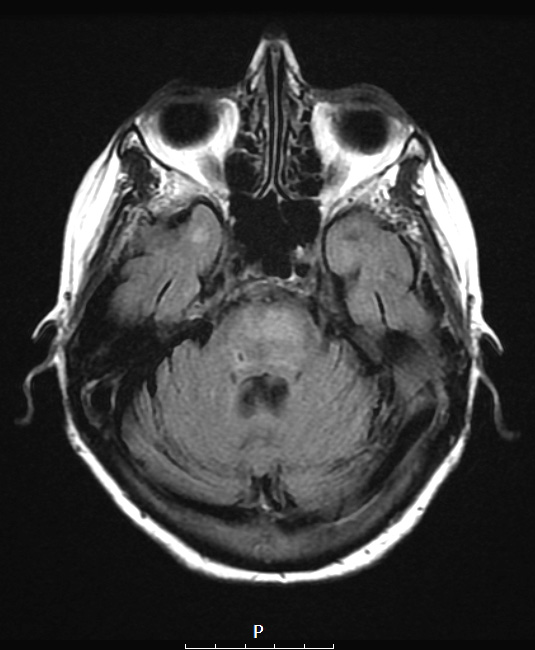 14A1 Lymphoma, Pons (Case 14) T2 FLAIR