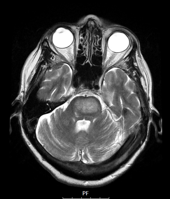 14A2 Lymphoma, Pons (Case 14) T2 NoC