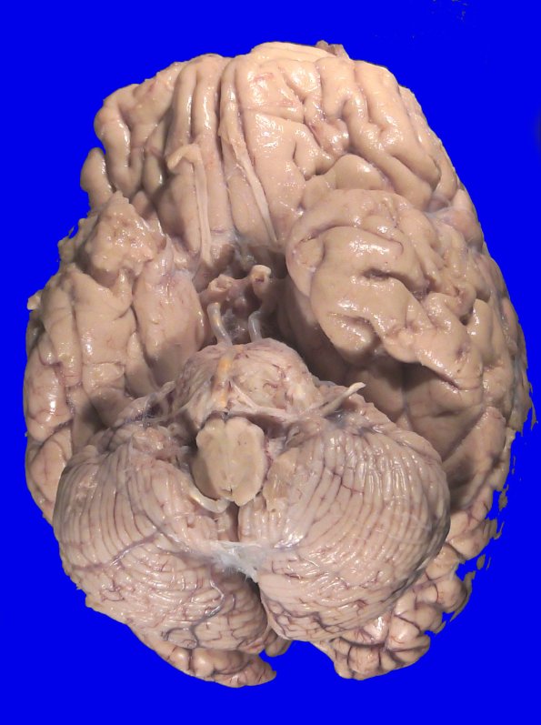 14B1 Lymphoma, Pons (Case 14) Gross_1