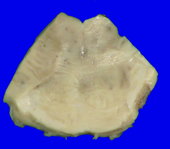 14B2 Lymphoma, Pons (Case 14) Gross_8