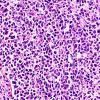 14C4 Lymphoma, Pons (Case 14) N18 H&E 40X