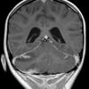 1A1 Lymphoma, anaplastic large T cell, secondary (Case 1) T1 W - Copy - Copy