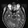 1A2 Lymphoma, anaplastic large T cell, secondary (Case 1) T2 W 1 - Copy - Copy