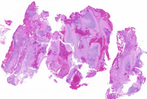 1B1 Lymphoma, anaplastic large T cell, secondary (Case 1) 1 H&E whole mount 2