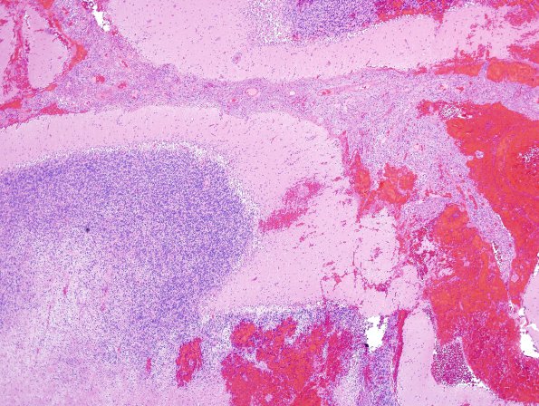 1B2 Lymphoma, anaplastic large T cell, secondary (Case 1) H&E 2.jpg