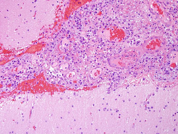 1B3 Lymphoma, anaplastic large T cell, secondary (Case 1) H&E 4.jpg