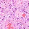 1B4 Lymphoma, anaplastic large T cell, secondary (Case 1) H&E 6.jpg