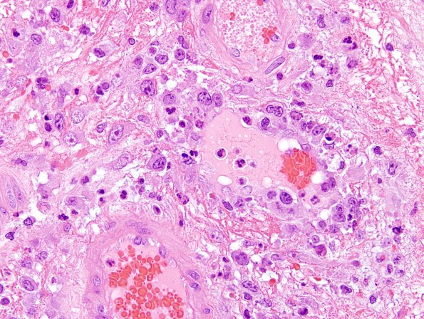 1B4 Lymphoma, anaplastic large T cell, secondary (Case 1) H&E 6.jpg