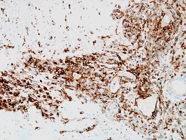 1C2 Lymphoma, anaplastic large T cell, secondary (Case 1) CD4 3.jpg