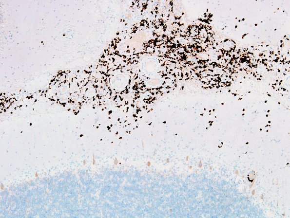 1C4 Lymphoma, anaplastic large T cell, secondary (Case 1) Alk1 3.jpg