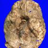 2A Lymphoma, secondary PTLD (Case 2) Gross 3