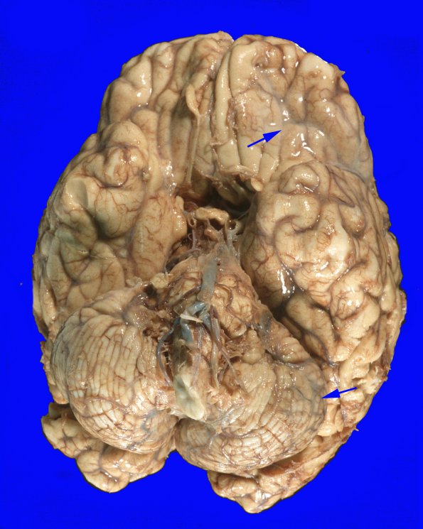 2A Lymphoma, secondary PTLD (Case 2) Gross 3