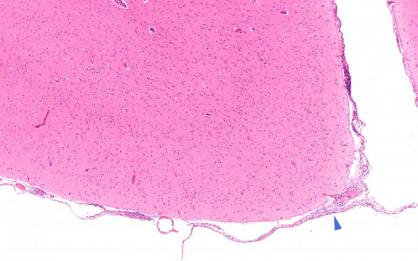 2B1 Lymphoma, secondary PTLD (Case 2) N3 10X copy