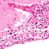 2B2 Lymphoma, secondary PTLD (Case 2) N3 40X